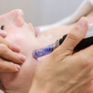 microneedling
